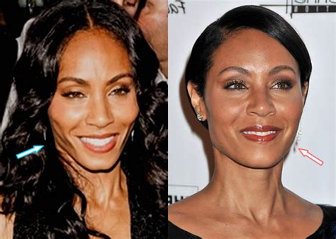 Jada Pinkett Smith Facelift Before And After Photo Compare In 2021
