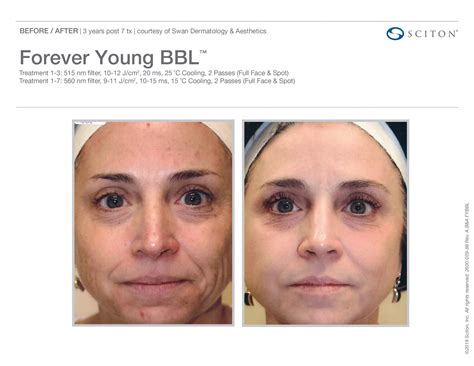Forever Young Bbl St Louis Mo Marelyse Medispa