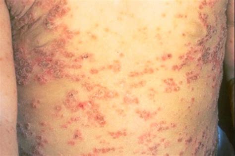 What Every Man Should Know About Psoriasis The Healthy