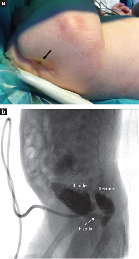 Urological Fistulas After Fetal Cystoscopic Laser Ablation Of Posterior Urethral Valves
