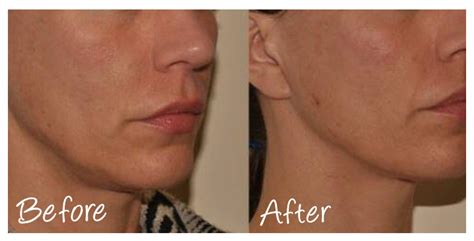 A Z Of Dermal Fillers Cosmetic Courses