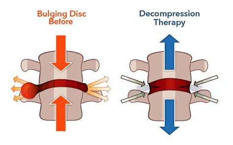 Spinal Decompression Surgery Types Risks Cost And Recovery