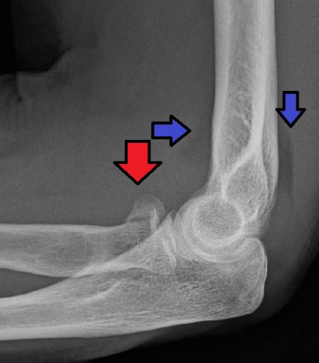 Radial Head Fracture Peds Wikem