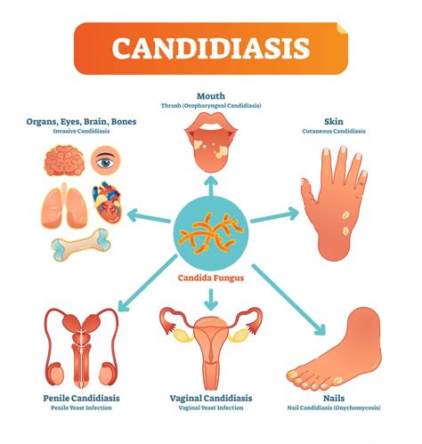 candidiasis causas síntomas y consejos blog de naturlíder blog de naturlíder