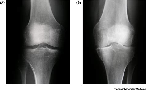 Genetic Determinism Of Primary Early Onset Osteoarthritis Trends In