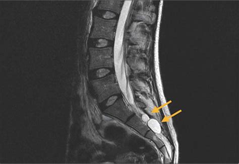 Tarlov Cysts In A Woman With Lumbar Pain Journal Of Orthopaedic