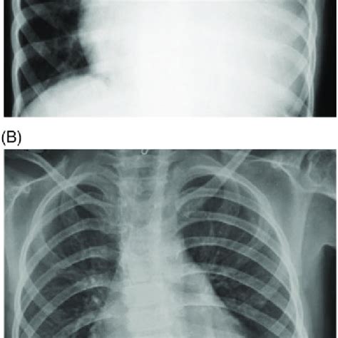 A Chest X Ray Pa View Showing Massive Cardiomegaly With Normal Lung