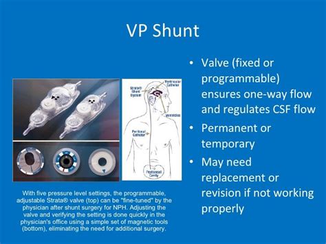 Image Result For Ventriculoperitoneal Shunt With Images Vp Shunt