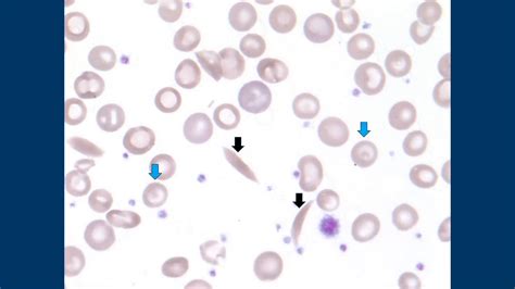 Sickle Cell Anemia Under The Microscope Peripheral Blood Smear Video