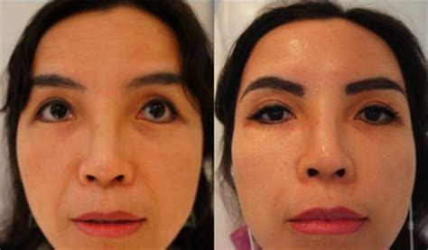 Non Surgical Face Shaping Best Clinic Sydney For Dermal Fillers