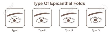 Type Of Epicanthal Folds Illustration Sponsored Paid Epicanthal