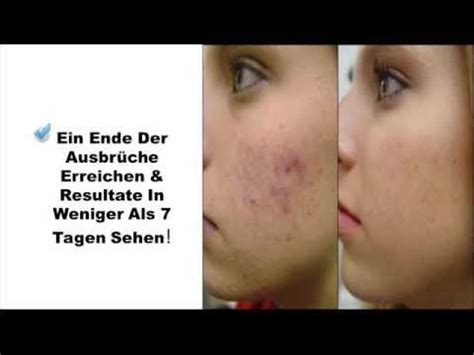 Auf diese weise kann sich die. Aknenarben Entfernen - YouTube