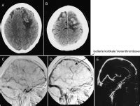 Trotzdem stimmt die aussage, die pille werde ohne aufklärung. Abbildungen und Graphiken: Sinus- und Hirnvenenthrombose