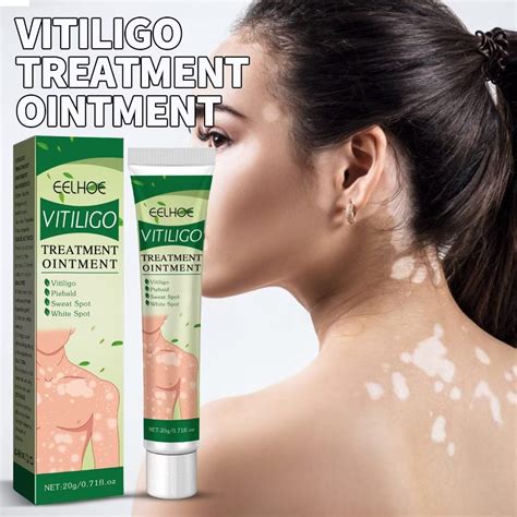 Kning 3pack Herbal Extract Vitiligo Ointment Remove Ringworm White Spot