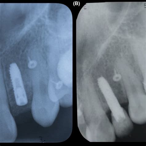 A Radiograph Initial Placement B Radiograph 4 Years Follow‐up