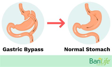 Gastric Bypass Reversal What Happens After Its Reversed