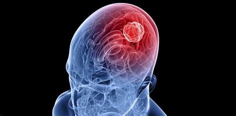 Glioblastoma What Is It Causes Symptoms And Treatment Mediologiest