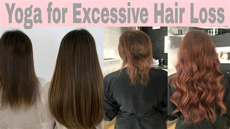 Solution For Hair Loss Because Of Hormonal Imbalance Youtube