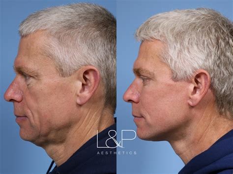 Laser Resurfacing Trl Before And After Photo Gallery Palo Alto