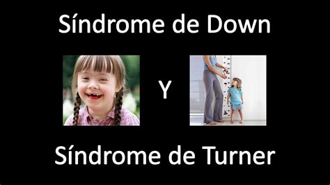 Análisis Comparativo Entre El Síndrome De Down Y El Síndrome De Turner Youtube