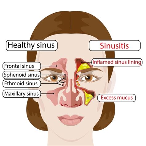Sinusitis Symptoms Diagnosis And Treatment Healthsoul