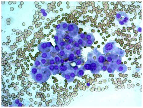 Cytological And Molecular Diagnosis Of Hürthle Cell Thyroid Tumors