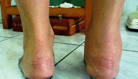 Does Ankle Arthritis Look Like Hot Sex Picture