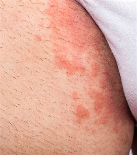 Groin Rash Stock Photos Pictures And Royalty Free Images Istock