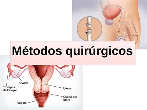 Métodos anticonceptivos definitivos o quirúrgicos La Verdad Noticias