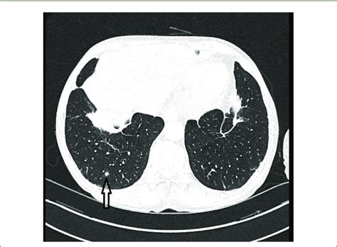 Ct Chest Coronal View Showing A Progressive Increasing Lung Nodule In