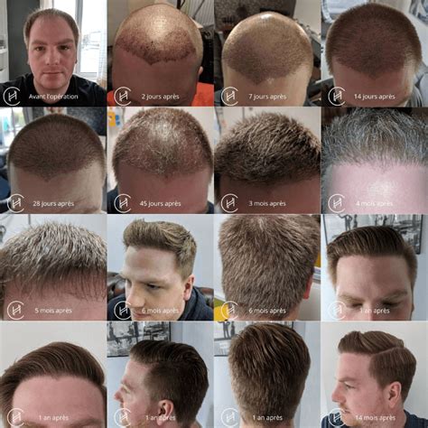 Greffe de cheveux: évolution mois par mois | 0 - 14 mois Photos