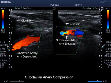 Peripheral Arterial Ultrasound Evaluations