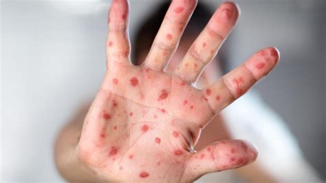 Hand Foot And Mouth Disease Cairns And Tablelands Childcare Centres