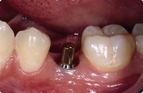 Which Implant Abutment Do You Choose Spear Education