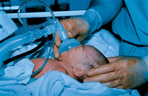 Resuscitation At Birth And Long Term Follow Up The Lancet