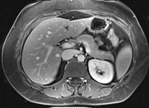 Normal Pancreas Mri Stock Image C0393163 Science Photo Library
