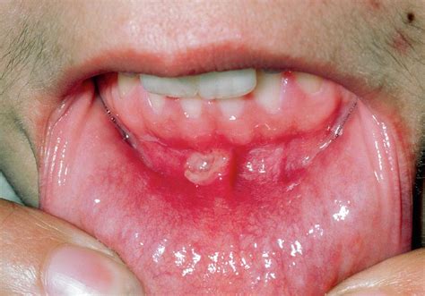Aphtha Mouth Ulcer On Base Of Gums Photograph By Dr P Marazziscience Photo Library
