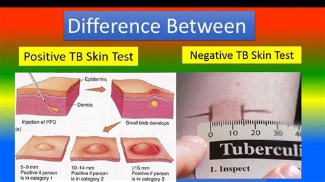 Difference Between Positive TB Skin Test And Negative TB Skin Test YouTube