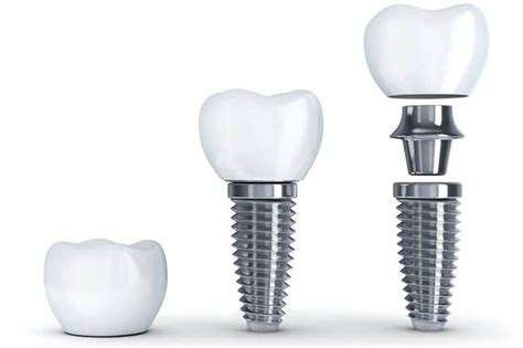 A Step By Step Guide To Dental Implants Costello Oral Surgery