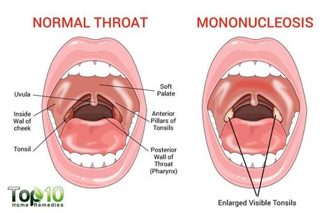 Someone with strep throat should start feeling better in just a day or two after starting antibiotics. Home Remedies to Treat Mononucleosis | Top 10 Home Remedies