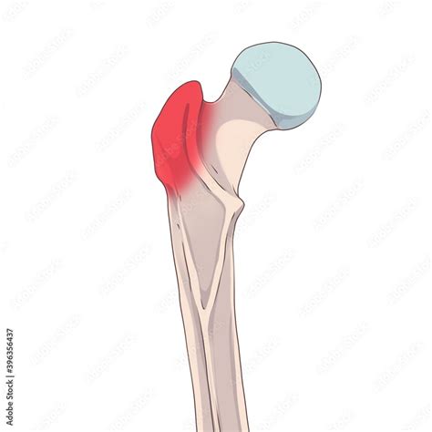 Greater Trochanter The Femur Or Thigh Bone Is The Proximal Bone Of