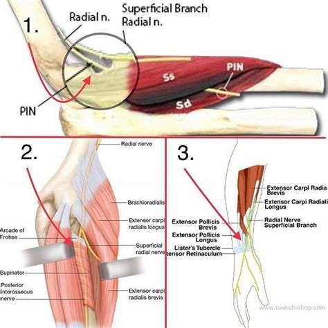 Forearm Radial Nerve Entrapment 3 Varieties Tennis Elbow Mimics 1