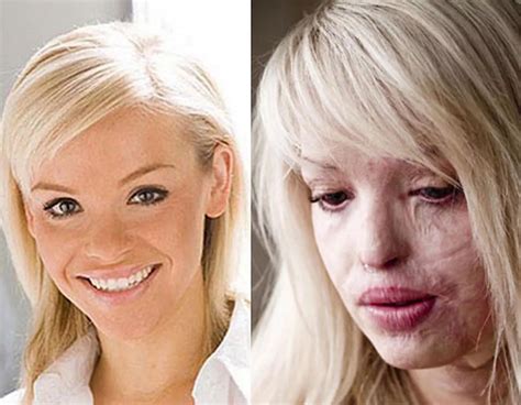 Katie Piper From Burns Victim To Mother And Bride Irish Mirror Online