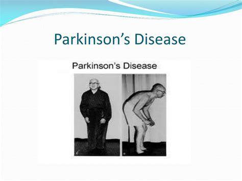 Ppt Parkinsons Disease Powerpoint Presentation Free Download Id3321799