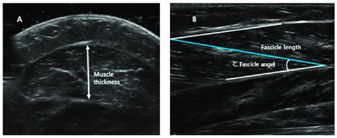 Measurements Of Medial Head Of The Gastrocnemius Muscle Thickness