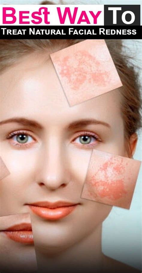 How To Treat Natural Facial Redness With Images Natural Facial