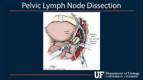 Pelvic Lymph Node Dissection Step By Step Procedure Urology YouTube