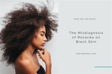 The Misdiagnosis Of Rosacea On Black Skin Refinedmd Los Gatos