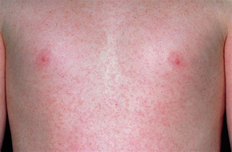 German Measles Rubella Rash On Chest Of A Child