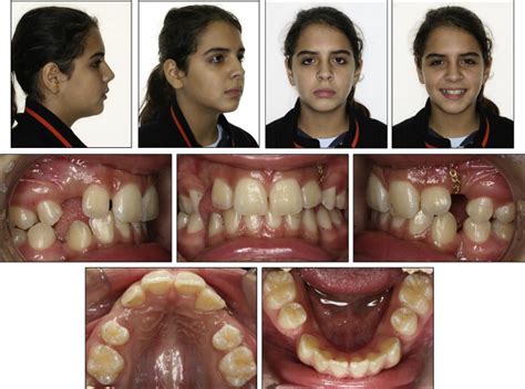 Orthodontic Uprighting Of Severely Impacted Mandibular Second Molars